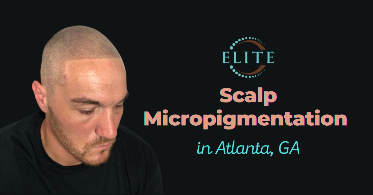 Scalp Micropigmentation in Atlanta, GA