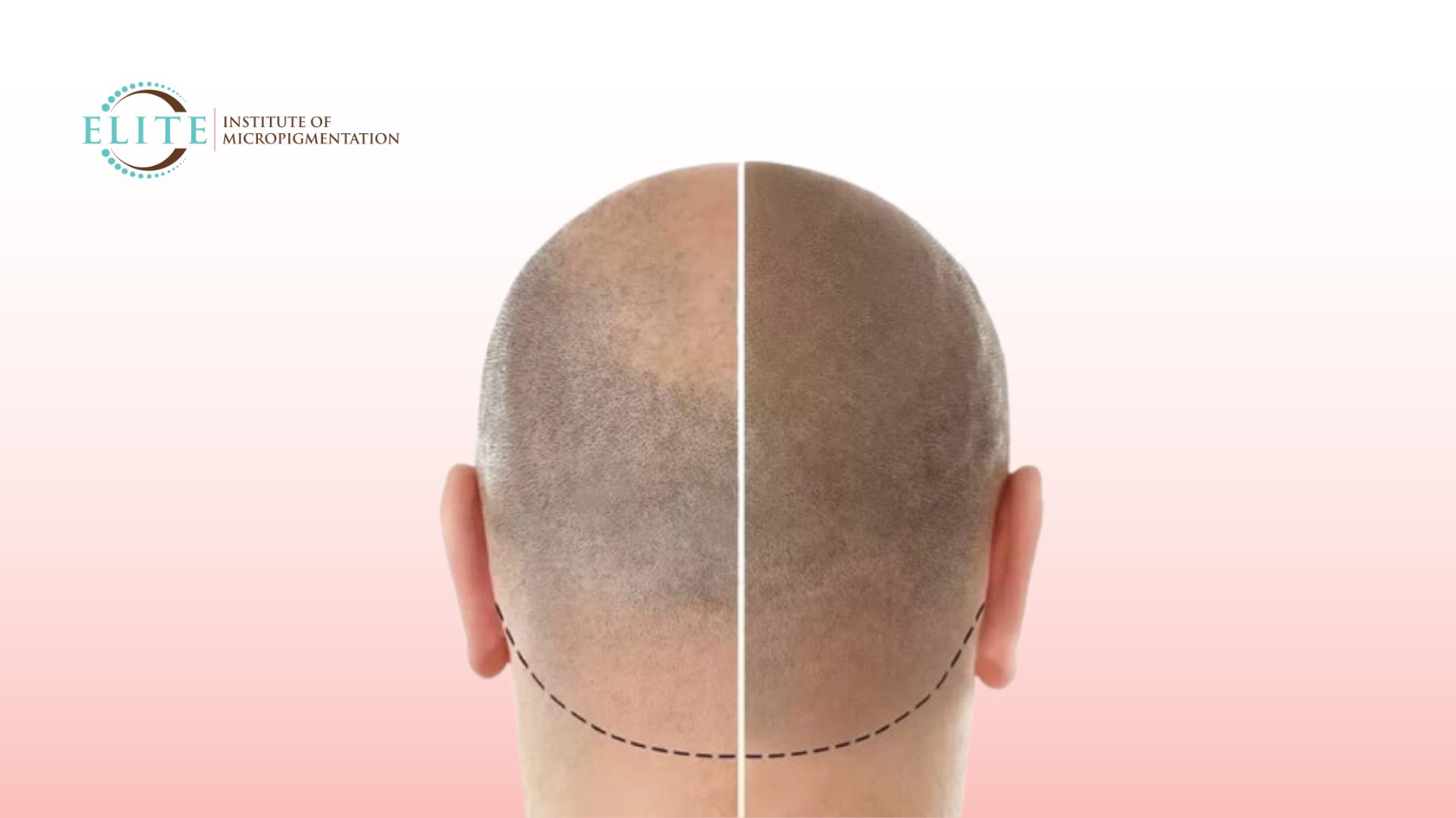 Everything You Need To Know About Scalp Micropigmentation