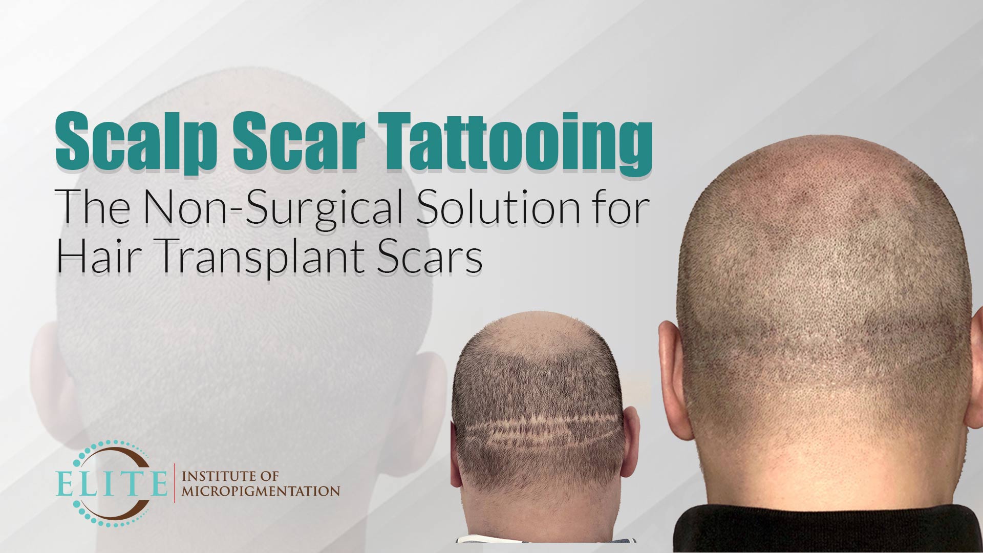 Scar Tattooing Using Scalp Micropigmentation