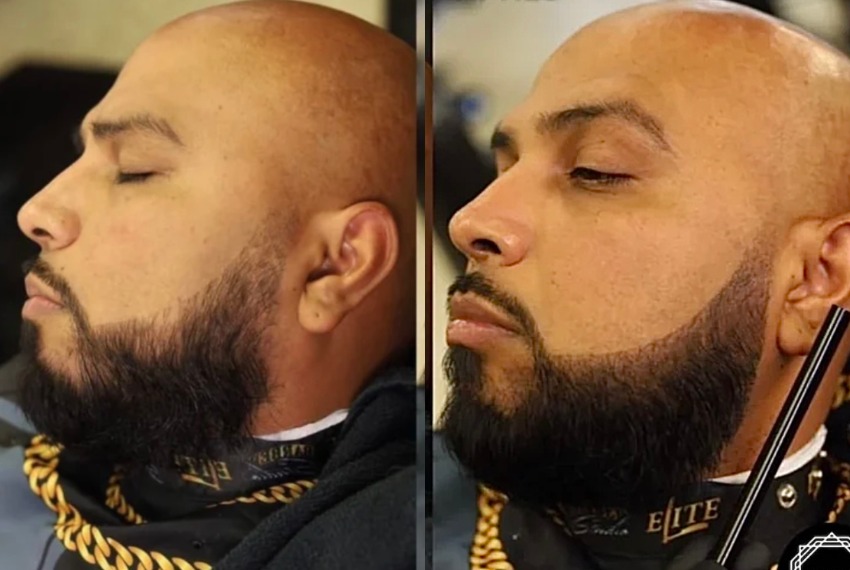 beard micropigmentation after result photos