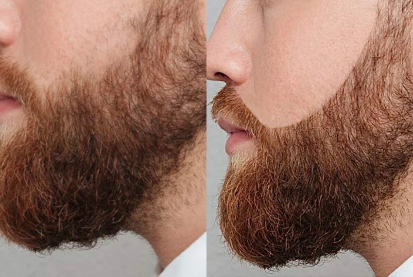 beard micropigmentation before after images