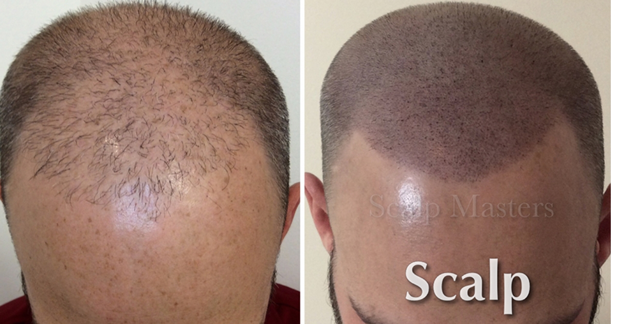 scalp-micropigmentation-in-atlanta