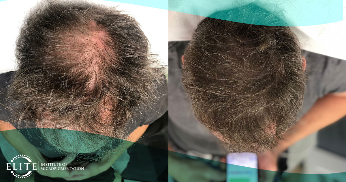 scalp-micropigmentation-after-hair-transplant-a-comprehensive-guid