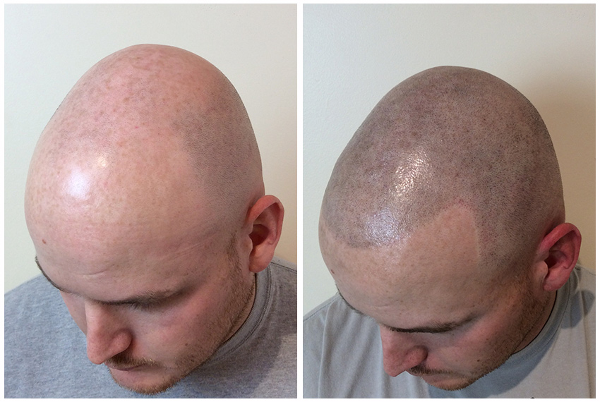 Scalp Micropigmentation Before and After Results