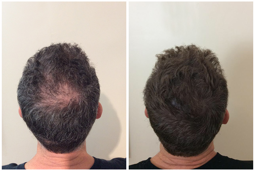 Scalp micropigmentation density treatment