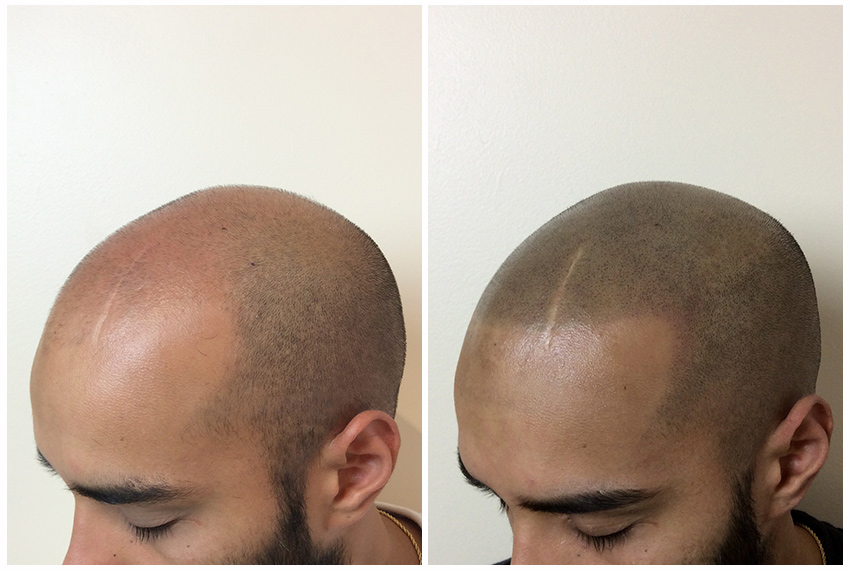 Scalp Micropigmentation for scar camouflaging- International Hairlines