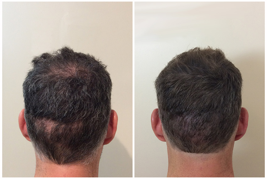 Scalp micro pigmentation for scars, scars camouflage.