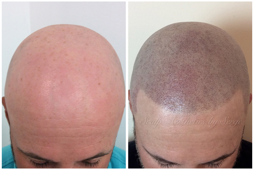 scalp micropigmentation before and after pictures