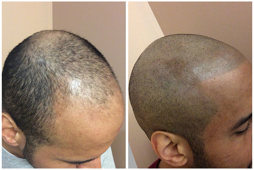 scalp micropigmentation before and after pictures