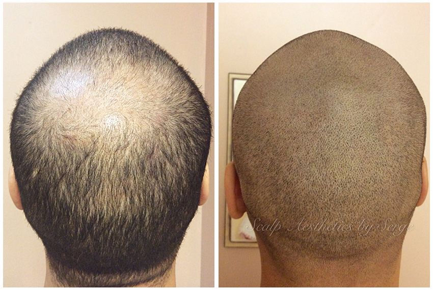 What is micro hair pigmentation or scalp micropigmentation? - 2pass Clinic