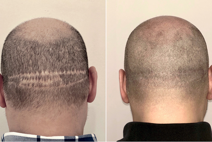 microblading 3D Hair Stroke technique at Elite Institute of Micropigmentation