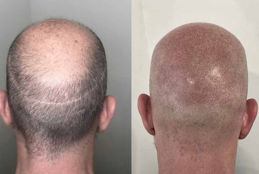 scalp micropigmentation services in Atlanta