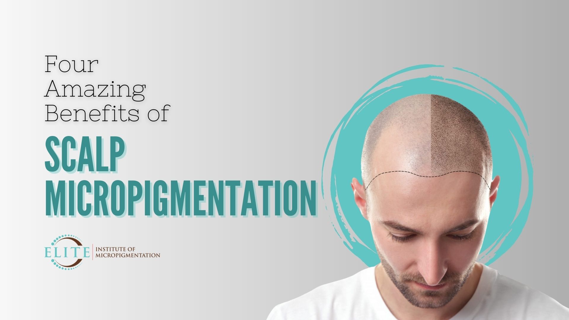 Benefits of Scalp Micropigmentation