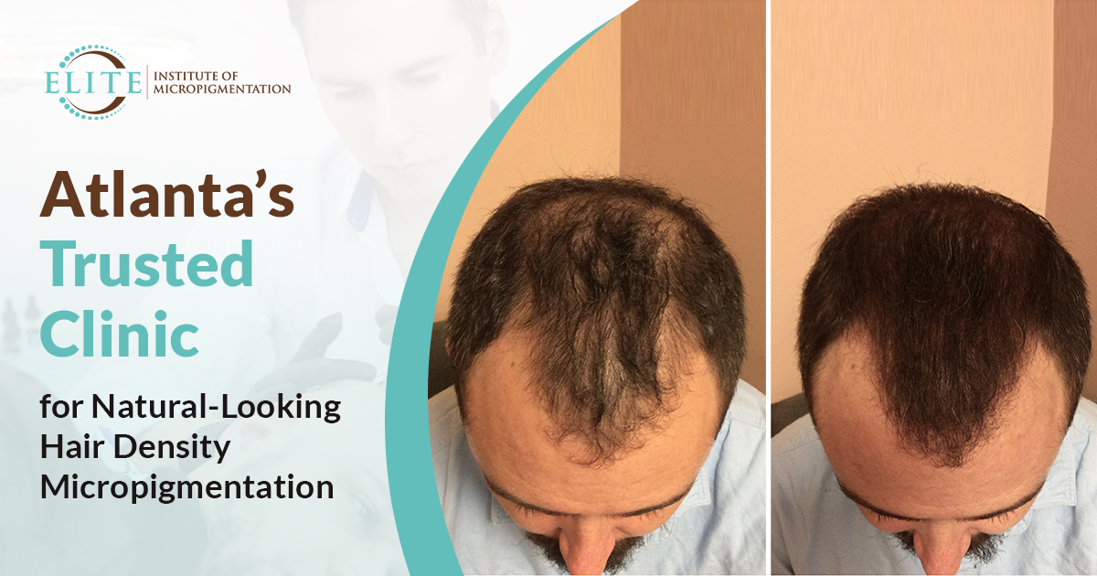 scalp-micropigmentation