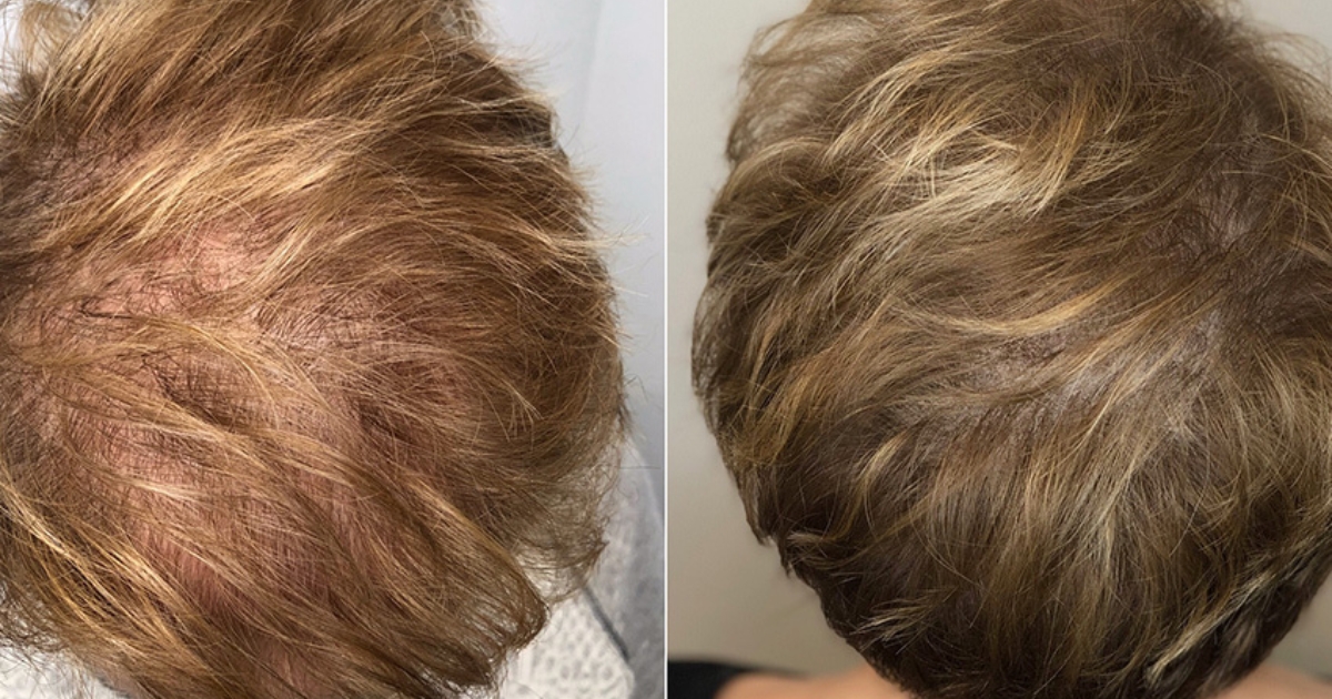 scalp-micropigmentation-in-atlanta