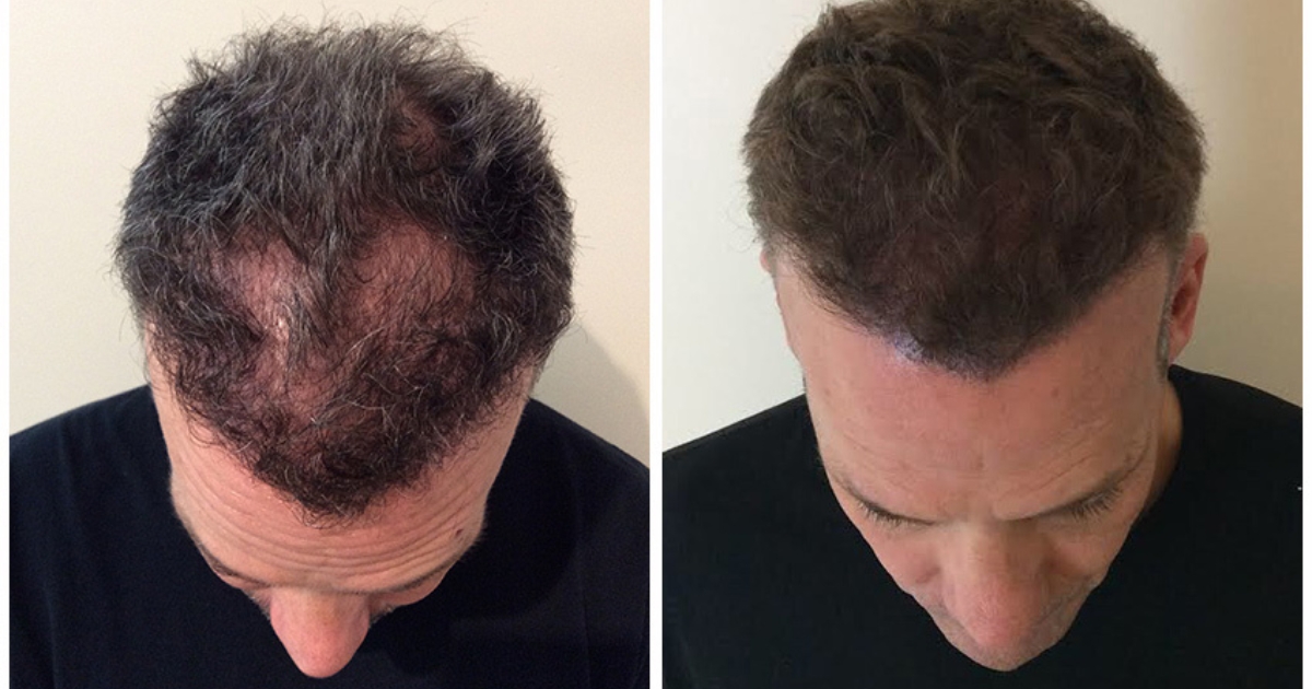 scalp-micropigmentation-in-atlanta