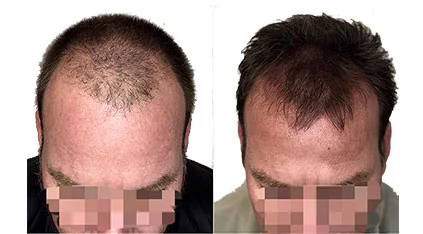 SMP Density Treatment for Thinning Hair Atlanta