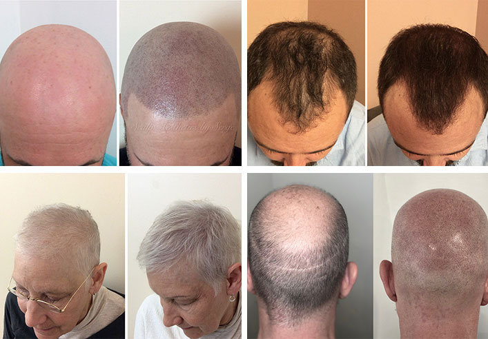 Scalp Micropigmentation Frequently Asked Questions