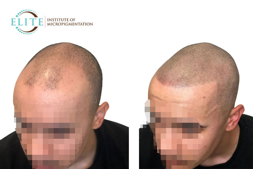 Scalp MicroPigmentation For Men - shaved effect and hairline restoration In Atlanta, GA
