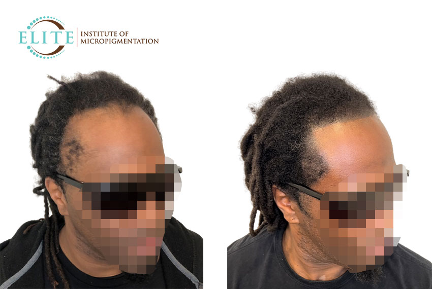scalp micro pigmentation density treatment In Atlanta, GA